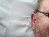 Konya Ereğli Akupunktur Tedavisi